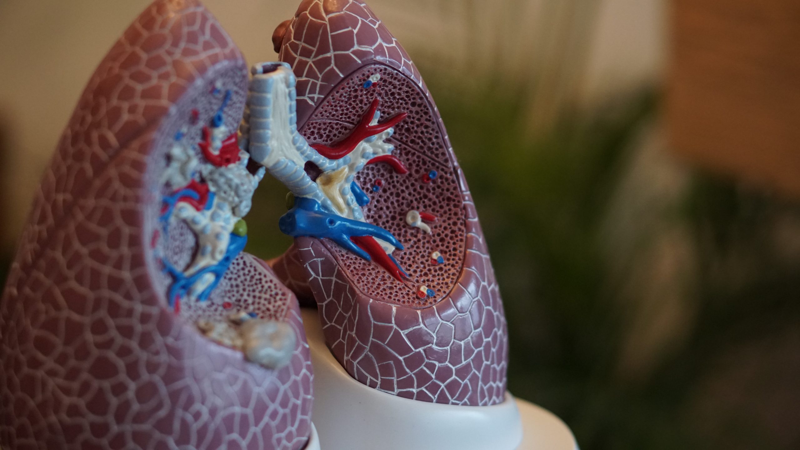 Silicosis personal injury